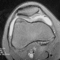 IRM du genou: coupe axiale en séquence FSE T2  avec suppression du signal de la graisse.