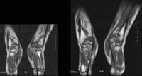 Défects osseux, IRM des 2 mains et poignets, séquence pondérée T1 en coupe sagittale (position de la prière).