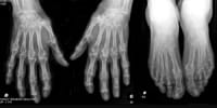 Radiographie des mains et avant-pieds de face.