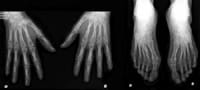 Radiographie de face des mains et des pieds.