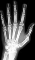 Radiographie de main et poignet de face.
