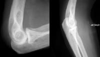Radiographie de coude de profil en flexion et extension.Arthrite du coude droit.