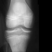 Radiographie de genou de face chez un garçon (16 ans) atteint d'arthrite juvénile idiopathique.
