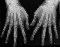 Radiographie des mains et poignets de face