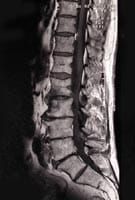 Discopathies pseudo-pottiques lombaire, IRM séquence T1, coupe sagittale