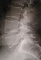 Spondylolysthésis par lyse isthmique L5,  et arthrose articulaire postérieure. Cliché standard de profil