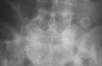 Syndrome de Baastrup avec néoarticulation interépineuse et arthrose interapophysaire postérieure
