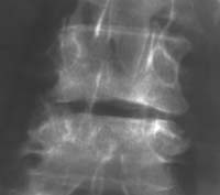 Latéroflexion droite chez le même patient démasquant un phénomène de vide discal qui permet d'écarter une spondylodiscite (flèches).