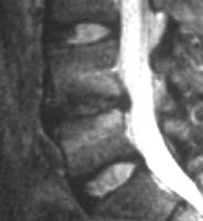 Discret hypersignal arciforme en miroir de type oedémateux à distance des plateaux vertébraux (flèches).