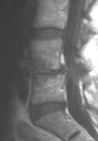IRM sagittale T1 après injection de gadolinium montrant un effacement partiel de l'&#353;dème de la partie antérieure des plateaux vertébraux (flèches) à l'étage du spondylolisthésis L4-L5.