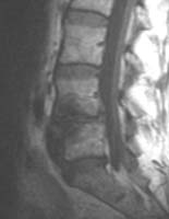 IRM sagittale T1 montrant la présence d'un &#353;dème en miroir de la partie antérieure des plateaux vertébraux  (flèche) en regard du spondylolisthésis arthrosique L4-L5.