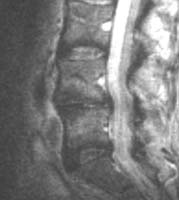 Même patient. IRM sagittale T2: discret &#353;dème à distance des plateaux vertébraux (flèche) de l'étage L4-L5. Effacement de signal du disque L4-L5.