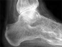 Arthrite ankylosante de l'arrière-pied et arthrite tibio tarsienne