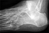 Arthrite ankylosante du médio-pied