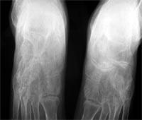 Arthrite ankylosante du médio-pied