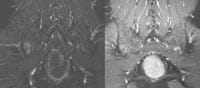 Sacro-iliite bilatérale postéro-inférieure.  Anomalies de signal bilatérales des deux berges articulaires inférieures, se réhaussant après injection