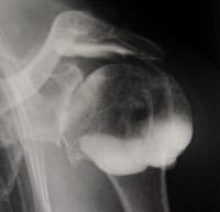 Omartrosis avanzada con rotura del manguito (artrografía)