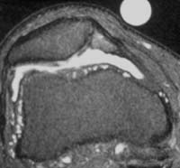 Corte axial FSE T2 Lesión femoropatelar