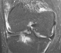 Gonartrosis y edema tibial e inflamación sinovial.  Corte frontal FSE T2.
