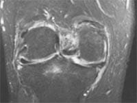 Gonartrosis y edema tibial e inflamación sinovial.  Corte frontal FSE T2.