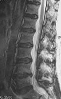 Discopatía erosiva y artrosis cigapofisaria.  Corte sagital FSE T2 con supresión de la señal de grasa.