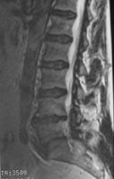 Discopatía erosiva y artrosis cigapofisaria.  Corte sagital FSE T2 con supresión de la señal de grasa.