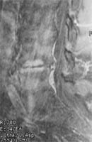 Discopatía erosiva y artrosis cigapofisaria.  Corte sagital FSE T2 con supresión de la señal de grasa e inyección de gadolinio.