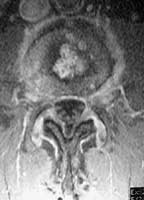 Discopatía erosiva y artrosis cigapofisaria.  Corte axial SE T2 con supresión de la señal de la grasa e inyección de gadolinio.