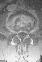 Discopatía erosiva y artrosis cigapofisaria.  Corte axial SE T1 con supresión de la señal de la grasa e inyección de gadolinio.