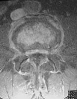 Discopatía erosiva y artrosis cigapofisaria.  Corte axial SE T1 con supresión de la señal de la grasa e inyección de gadolinio.