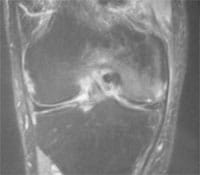 Corte frontal FSE T2 con supresión de la señal de grasa.  Parte central del compartimento femorotibial.