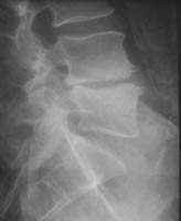 Discoartrosis y artrosis cigapofisaria.  Raquis lumbar de perfil: discoartrosis L4-L5 con osteofitosis corpórea anterior y artrosis articular posterior.