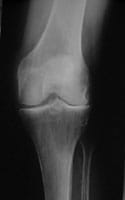 Artrosis femorotibial externa de la rodilla