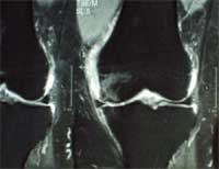 Gonartrosis femorotibial interna.  Con Resonancia magnética T2.