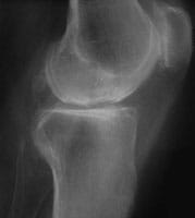 Artrosis femorotibial interna con necrosis condilar en proyección