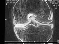 Gonartrosis en radiografías normales