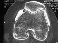 Gonartrosis en radiografías normales