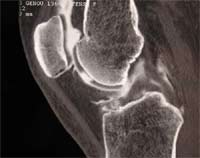Artrosis femoropatelar.  Artrografía de rodilla, reconstrucción sagital, ventana ósea.
