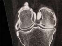 Artrosis femorotibial interna y externa.  Artro TAC de la rodilla.