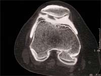 Artrosis femoropatelar.  Artro TAC, corte transversal, ventana ósea.