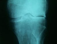 Osteonecrosis del cóndilo externo que se manifiesta con una pérdida del contorno del cóndilo que refleja el hundimiento subcondral