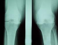 Pinzamiento femorotibial interno bilateral más acentuado a la derecha, con osteofitosis y esclerosis subcondral