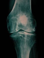 Fragmentación e irregularidades de los núcleos epifisarios que caracterizan la displasia poliepifisaria y responsable aquí de una artrosis femorotibial