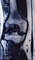 Gonartrosis secundaria osteonecrosis.  Resonancia magnética, secuencia T1, corte frontal.