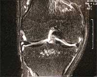 Artrosis femorotibial externa.  Resonancia magnética, secuencia T2, corte frontal.
