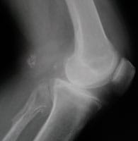 Artrosis femorotibial y peroneotibial superior con presencia de numerosos osteocondromas