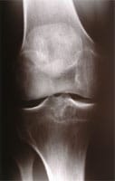 Artrosis femorotibial externa.