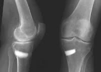 ASPECTO DE UNA OSTEOTOMÍA DE VARIZACI&#8221;N PARA ARTROSIS DE RODILLA MEDIANTE IMPLANTACI&#8221;N DE BIOMATERIAL