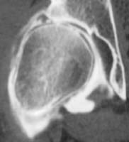 Artro TAC de cadera (reconstrucción frontal) - Julio de 2002