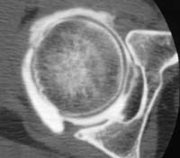 Artro TAC de cadera (corte axial) - Julio de 2002